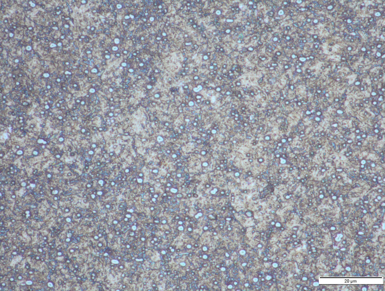 1000X-V4E 8 % Carbide Volume.jpg